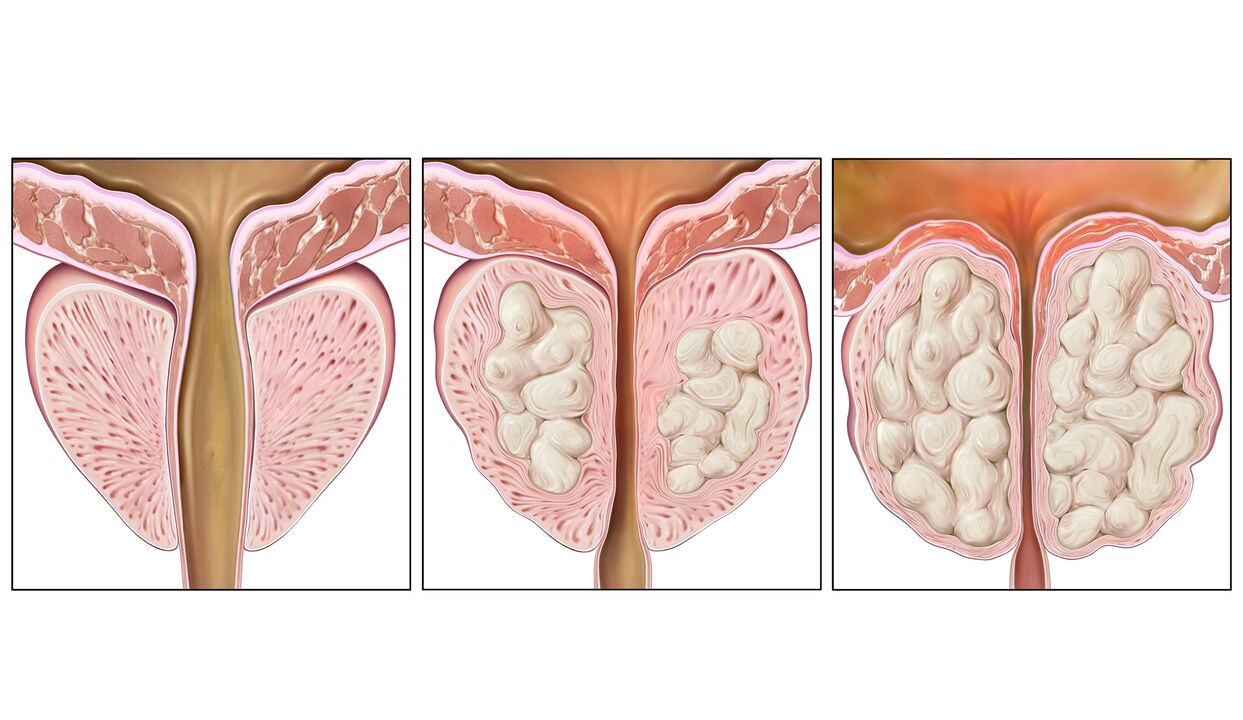 eesnäärmevähi staadiumid