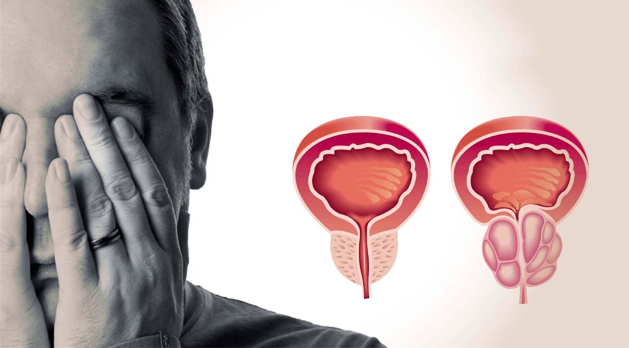 krooniline prostatiit meestel